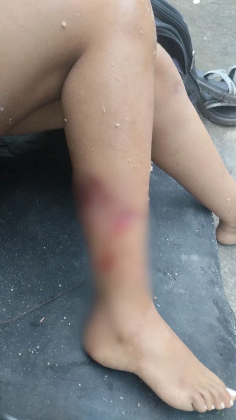 Grávida de 17 anos é atacada por pitbull em via pública de MG