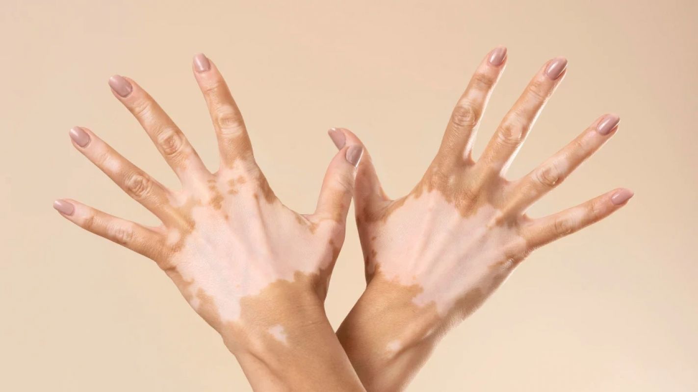 Ipatinga celebra o Dia Mundial do Vitiligo com campanhas de conscientização!