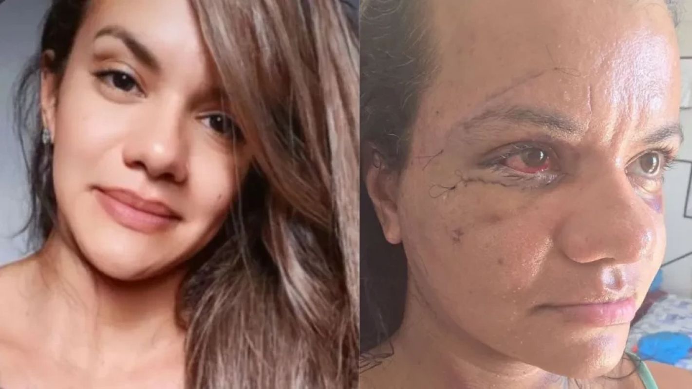 Após reconstrução facial, mulher agredida com 61 socos mostra rosto no RN