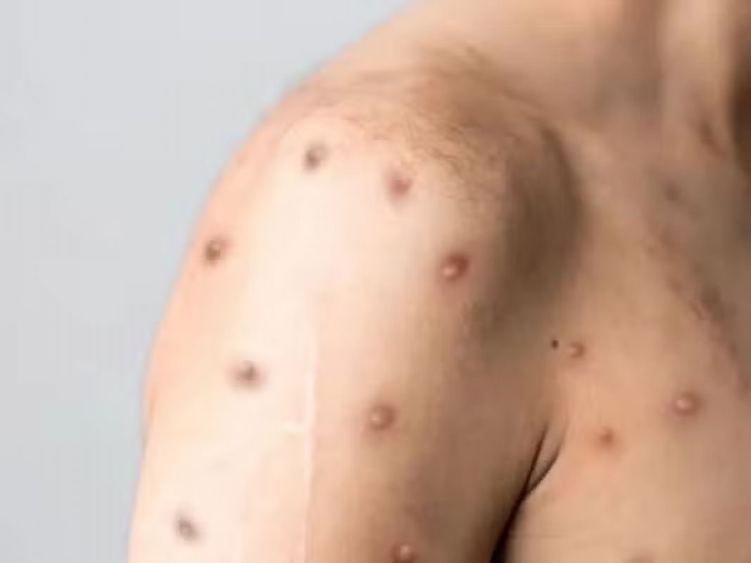  Governador Valadares investiga dois casos suspeitos de mpox; pacientes estão em isolamento