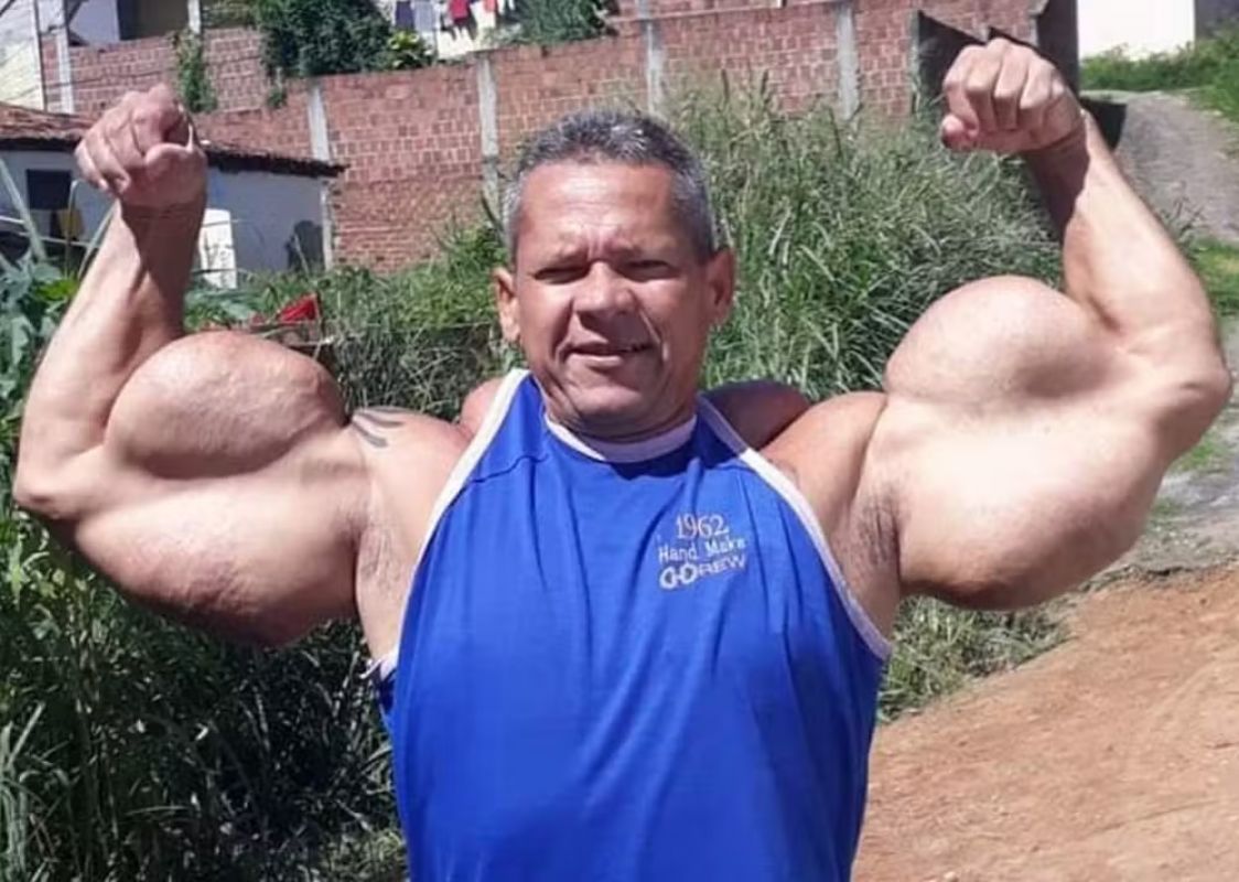  'Popeye Brasileiro' morre no Recife aos 55 anos; ele ficou famoso após injetar óleo mineral nos braços