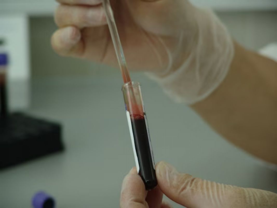 Paciente com HIV fica seis anos sem sinais do vírus após transplante de células-tronco