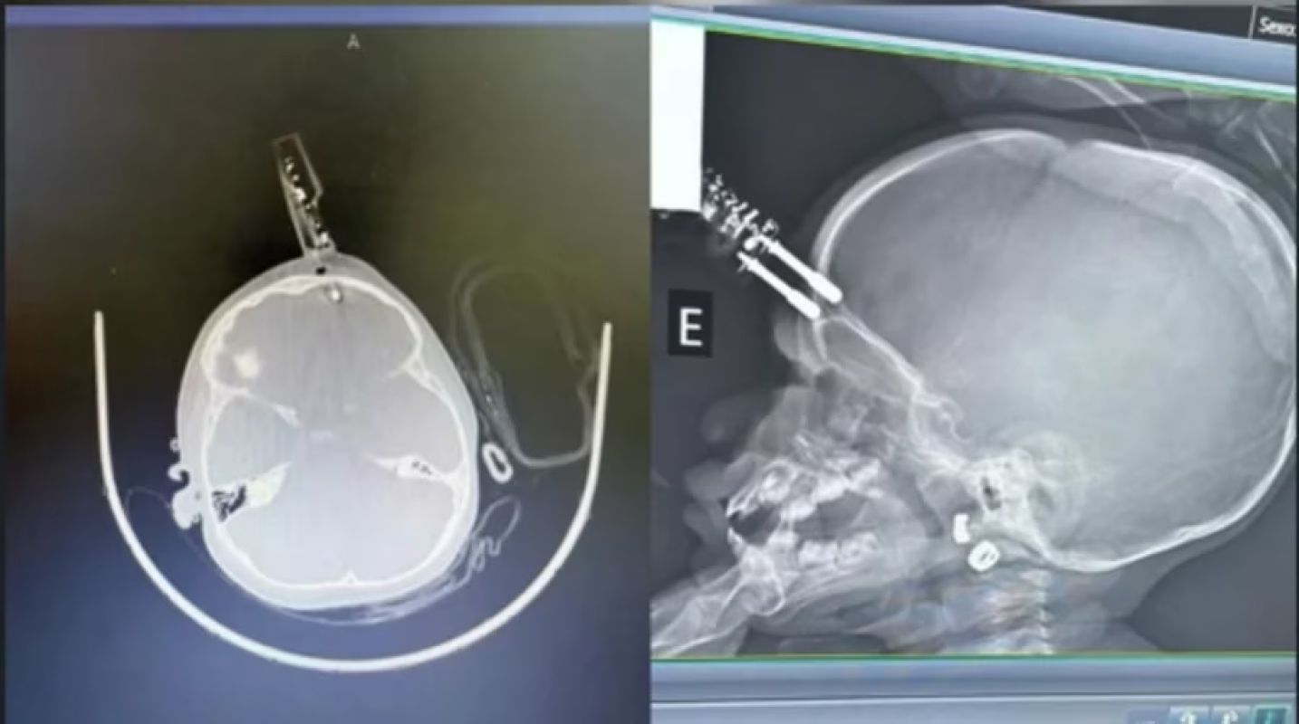 Bebê de 1 ano passa por cirurgia após ter carregador cravado na testa em Divinópolis