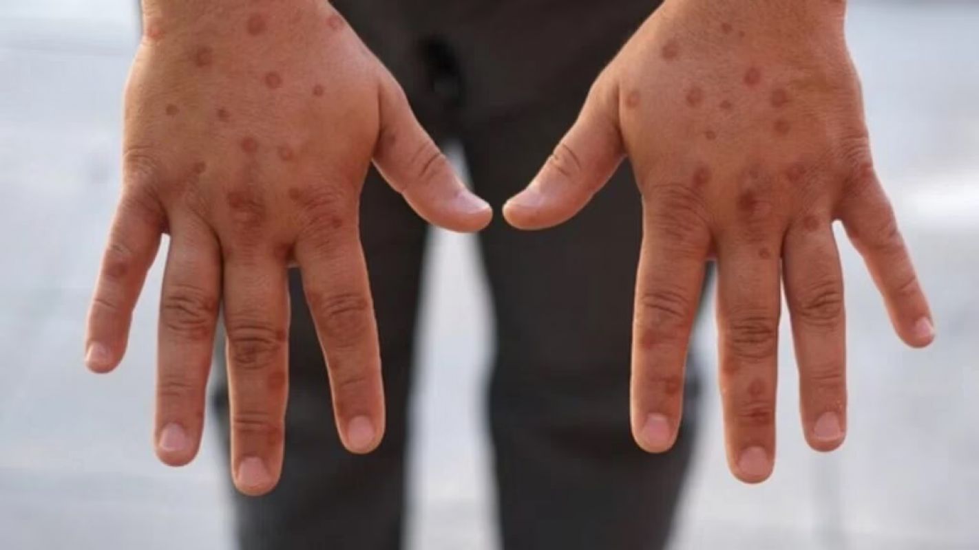 Minas Gerais chega a cinco casos confirmados de mpox em 2026, diz SES-MG