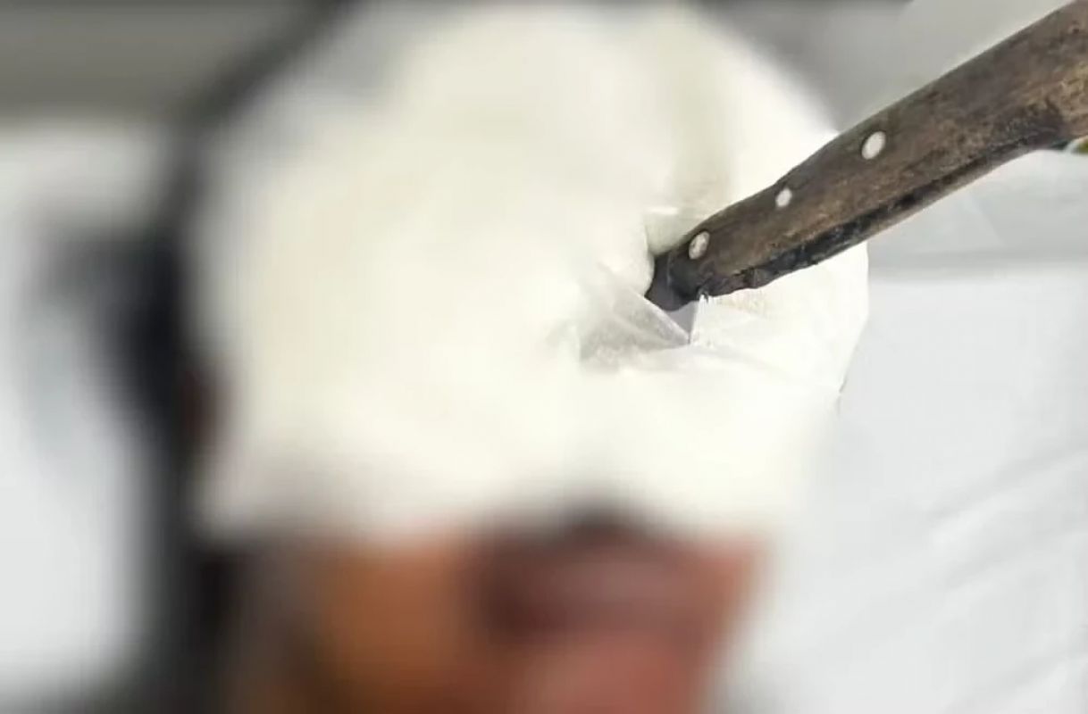 Disputa por terreno termina com faca no olho e traumatismo craniano em Teófilo Otoni