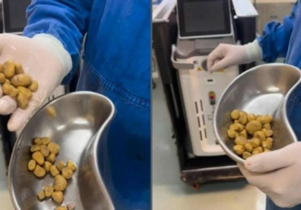  Após anos bebendo 3L de refrigerante por dia, homem passa por cirurgia e médico retira 35 pedras da bexiga