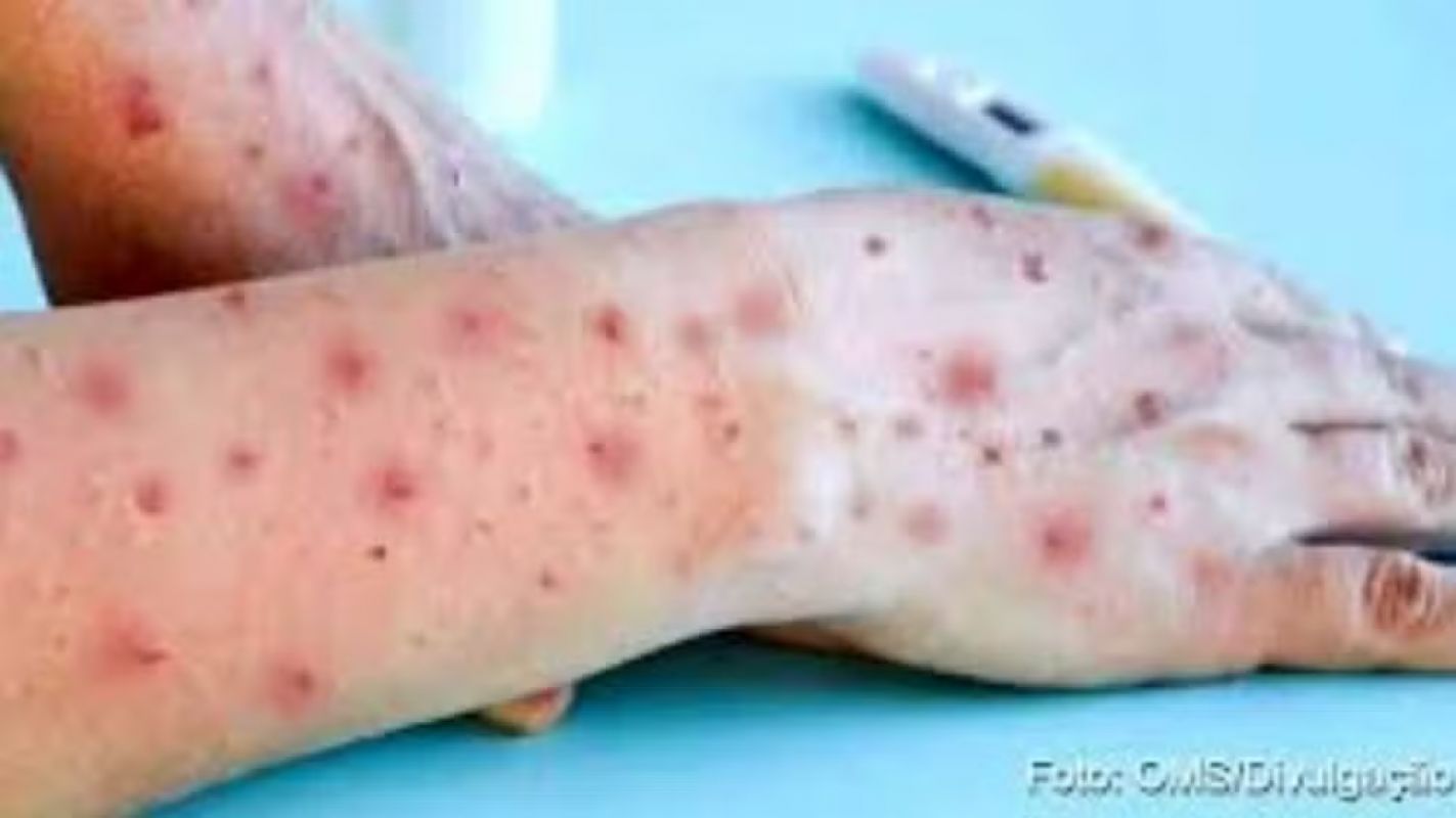 Mpox: Manhuaçu tem o primeiro caso confirmado
