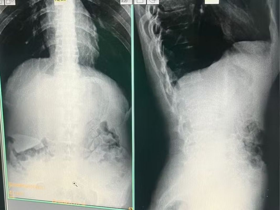  Cinco presos são flagrados com drogas no estômago ao retornar de 'saidinha' em MG