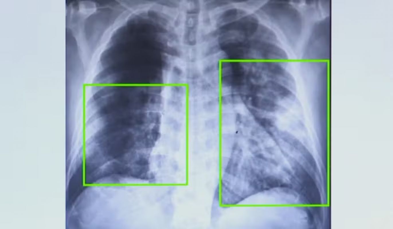 Casos de pneumonia sobem 20% em SP, e vacina gratuita pelo SUS tenta conter formas graves
