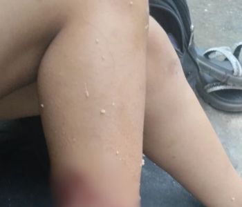 Grávida de 17 anos é atacada por pitbull em via pública de MG
