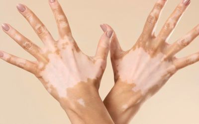 Ipatinga celebra o Dia Mundial do Vitiligo com campanhas de conscientização!