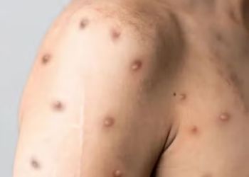  Governador Valadares investiga dois casos suspeitos de mpox; pacientes estão em isolamento