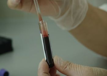 Paciente com HIV fica seis anos sem sinais do vírus após transplante de células-tronco