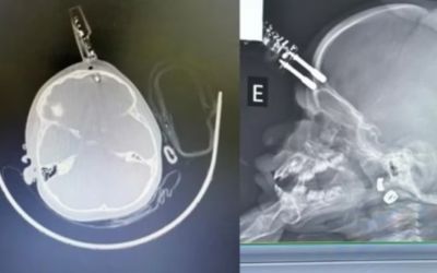 Bebê de 1 ano passa por cirurgia após ter carregador cravado na testa em Divinópolis