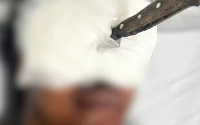 Disputa por terreno termina com faca no olho e traumatismo craniano em Teófilo Otoni
