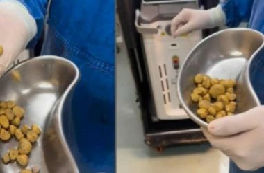  Após anos bebendo 3L de refrigerante por dia, homem passa por cirurgia e médico retira 35 pedras da bexiga