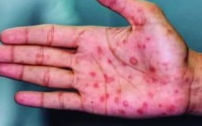 BH supera 4 mil casos de sífilis e alerta para avanço da doença