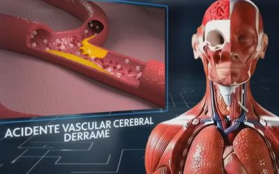 Casos de AVC em jovens disparam no Brasil e acendem alerta