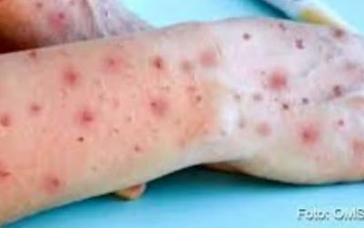 Pacientes com suspeita de mpox testam negativo para a doença em Governador Valadares
