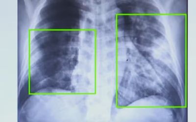 Casos de pneumonia sobem 20% em SP, e vacina gratuita pelo SUS tenta conter formas graves