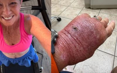 Corte com papelão infecciona e leva mulher ao hospital; foto viraliza